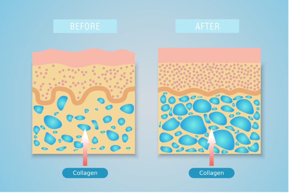 kolagen ovoderm skeeneffect